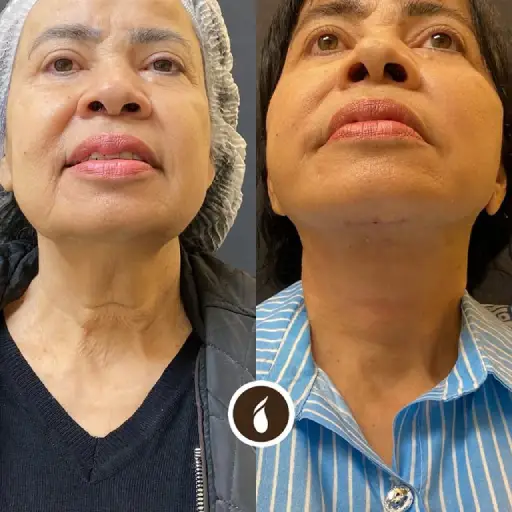 Antes e Depois do Procedimento de Lipo de Papada em Goiânia