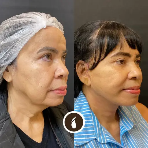 Antes e Depois do Procedimento de Lipo de Papada em Goiânia