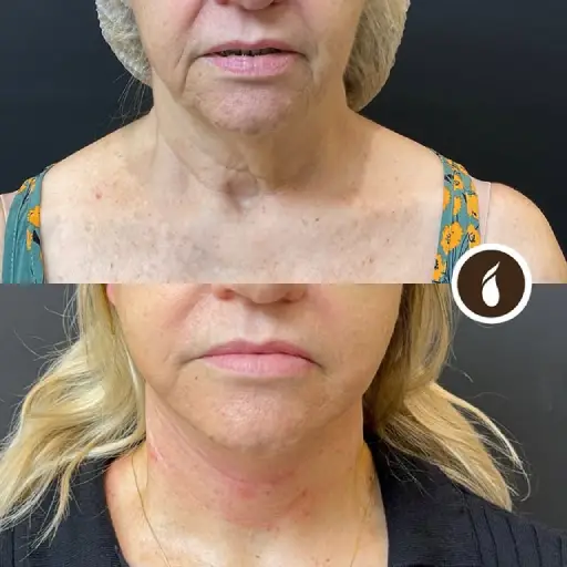 Antes e Depois do Procedimento de Lipo de Papada em Goiânia