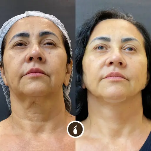 Antes e Depois do Procedimento de Lipo de Papada em Goiânia