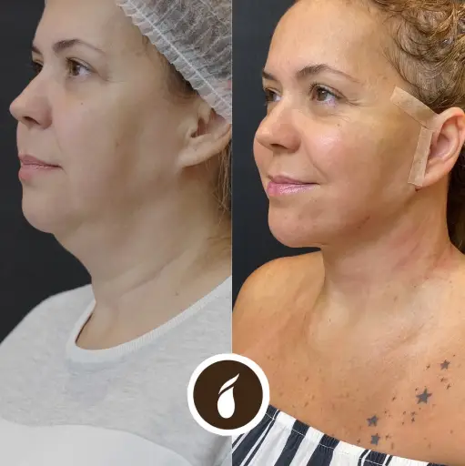 Antes e Depois do Procedimento de Lipo de Papada em Goiânia