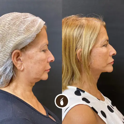 Antes e Depois do Procedimento de Lipo de Papada em Goiânia
