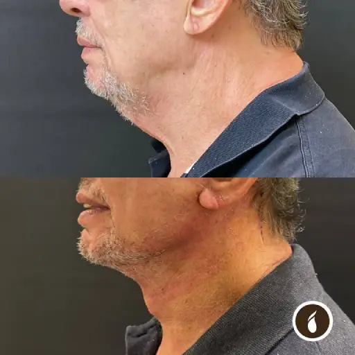 Antes e Depois do Procedimento de Lipo de Papada em Goiânia