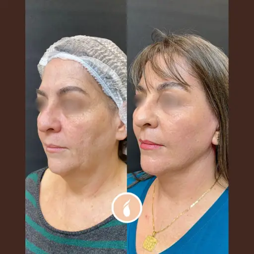 Antes e Depois do Procedimento de Lipo de Papada em Goiânia