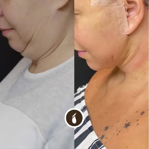 Antes e Depois do Procedimento de Lipo de Papada em Goiânia